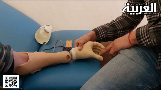 نجاح أول عملية تركيب يد إصطناعية إلكترونية