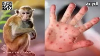 تسجيل أول حالة مؤكدة بجدري القردة في المغرب